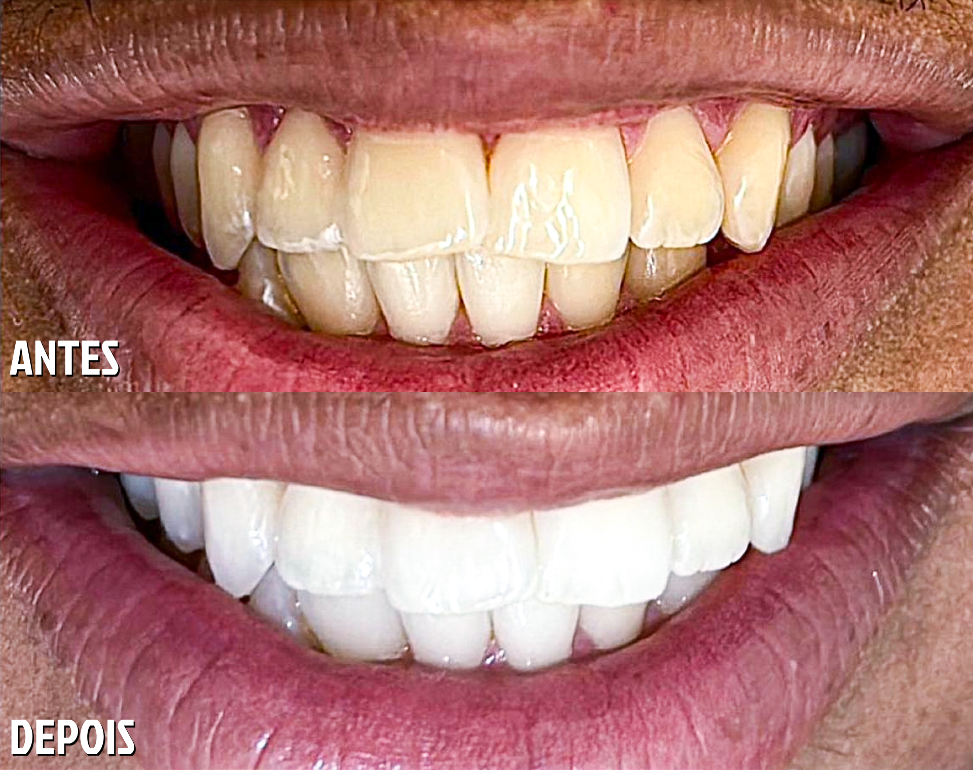 Antes e Depois Odontológico 1