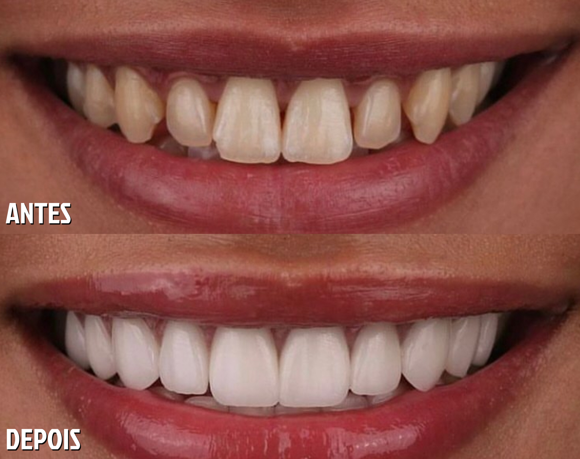 Antes e Depois Odontológico 2
