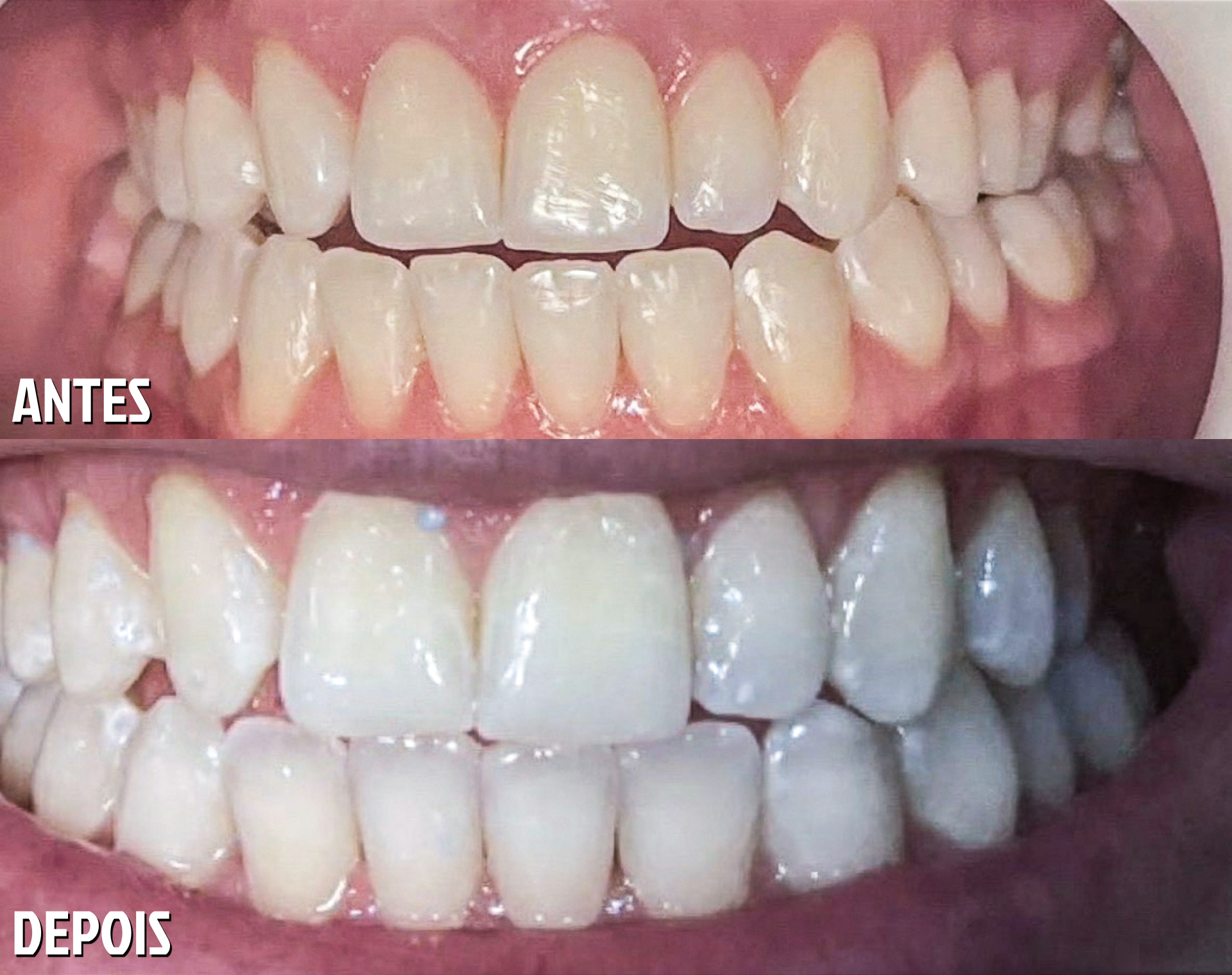 Antes e Depois Odontológico 4