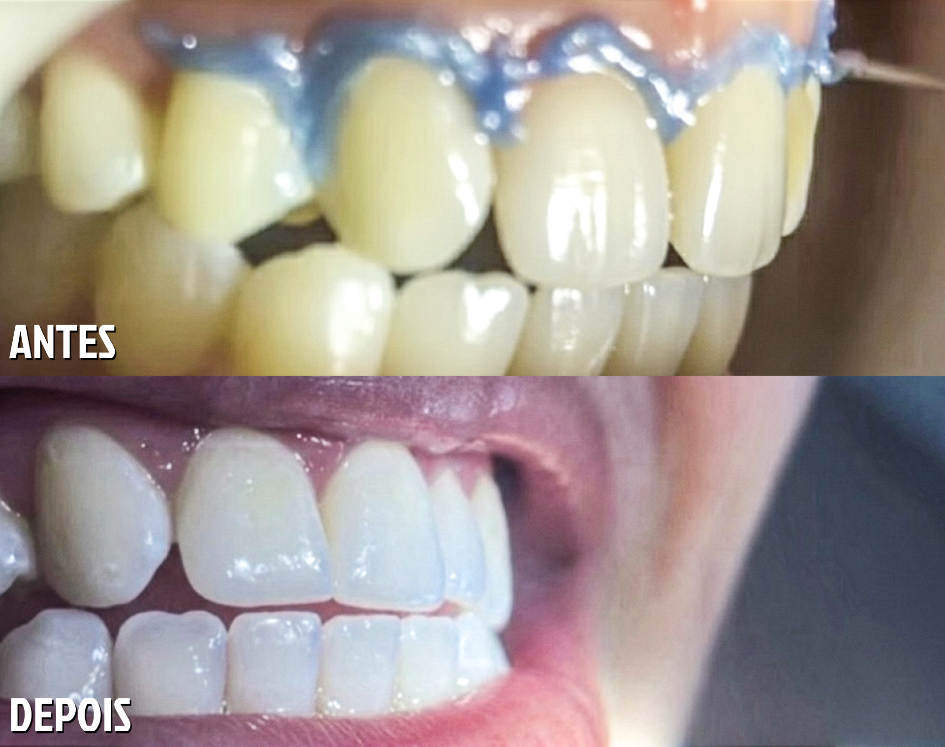 Antes e Depois Odontológico 5