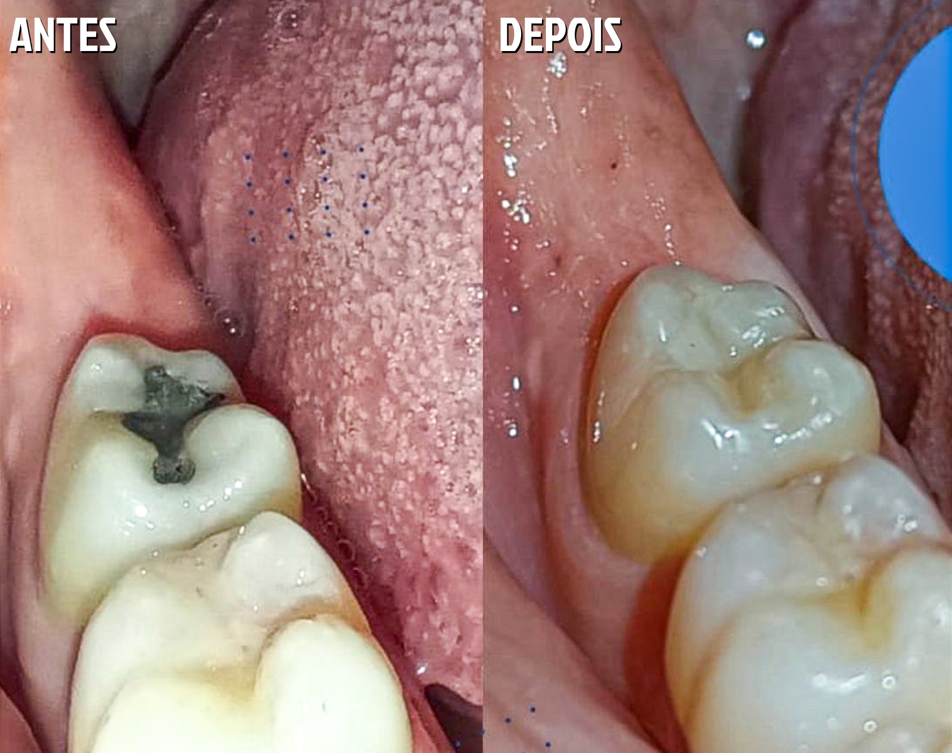 Antes e Depois Odontológico 6