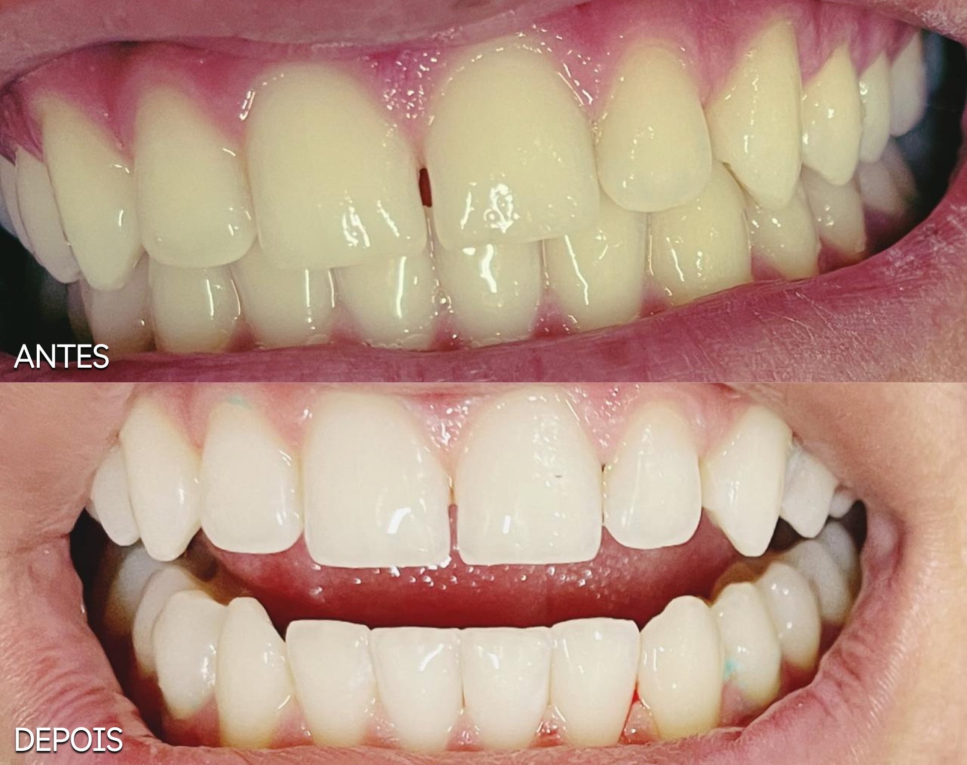 Antes e Depois Odontológico 7